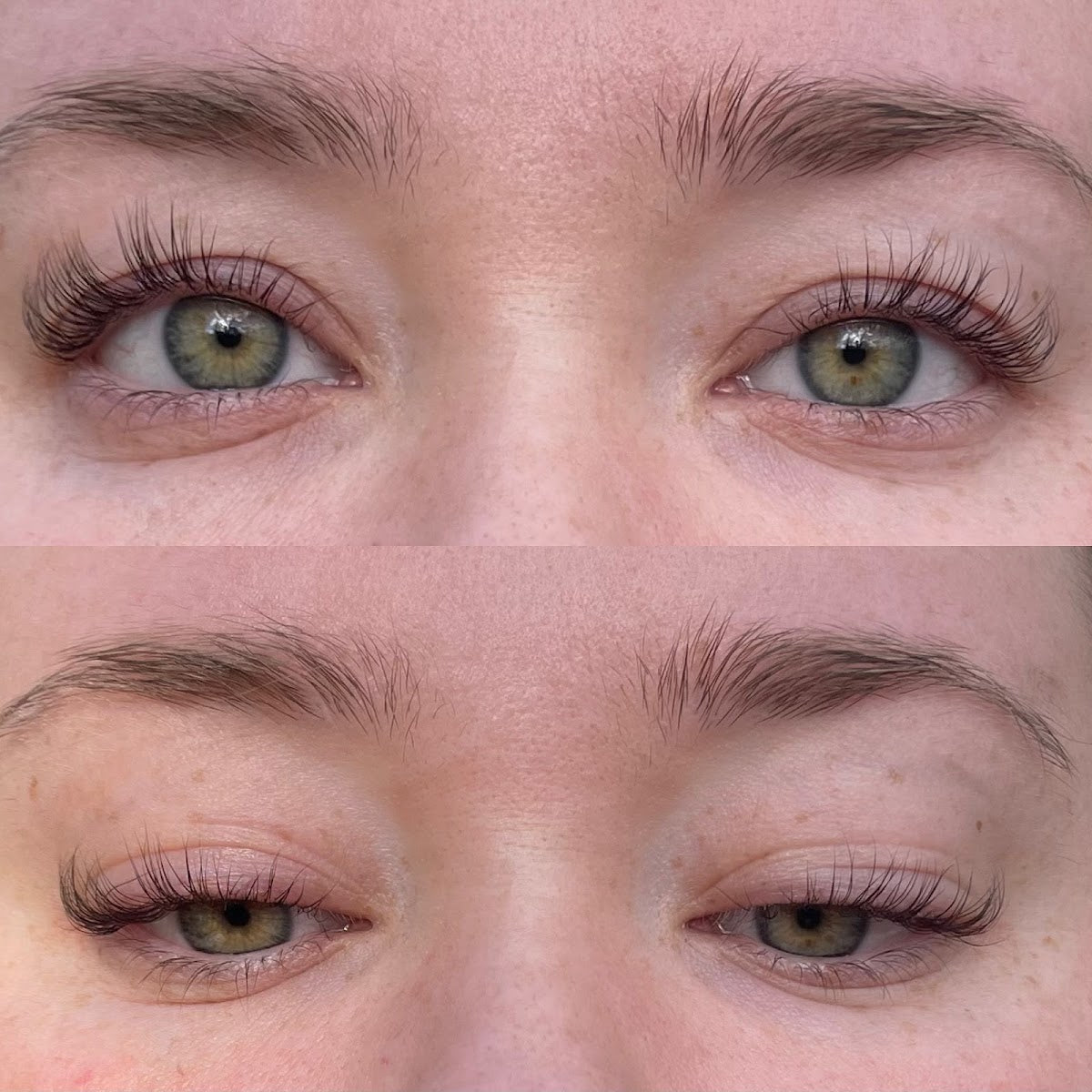Arndt Aesthetics | Hair Transplant | Concord, NH