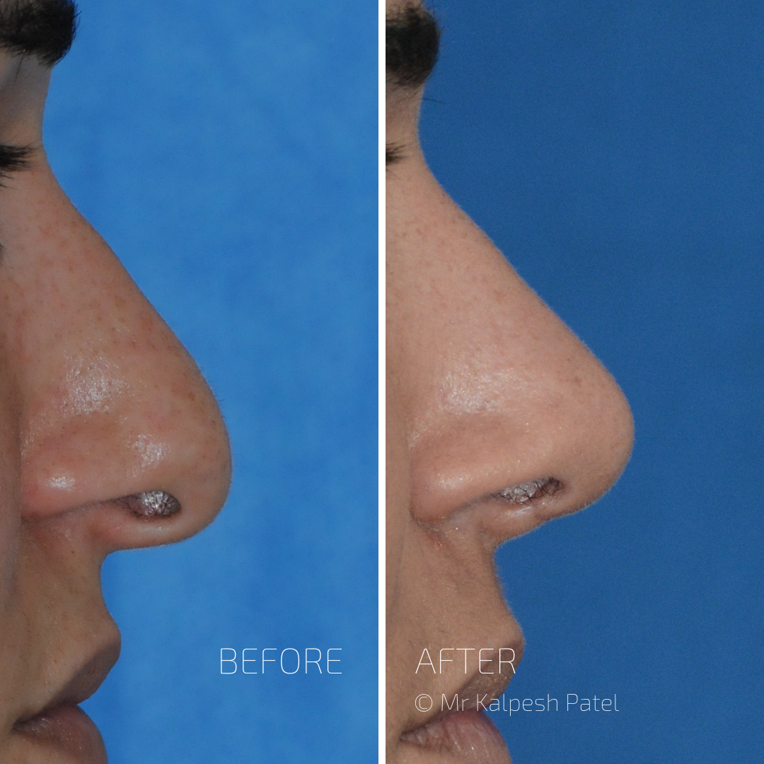 London Rhinoplasty — Aesthetic Surgery Clinic in London