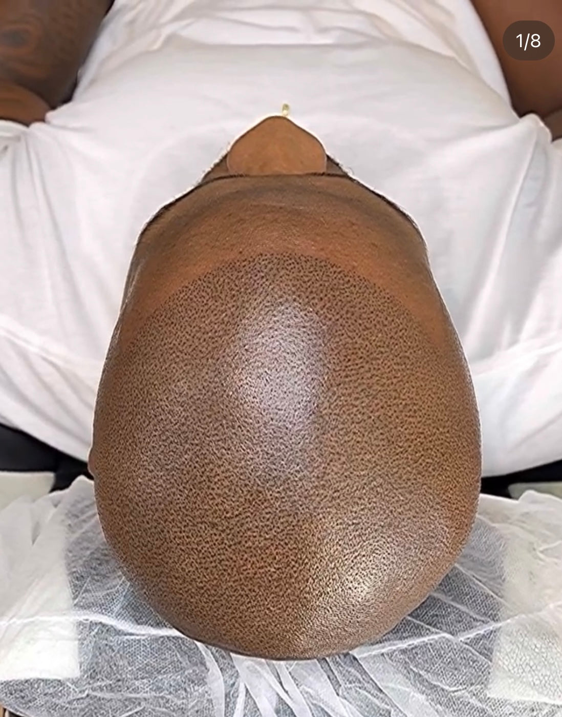 Scalp Godz | Hair Transplant | 3234 S Wadsworth Blvd, CO