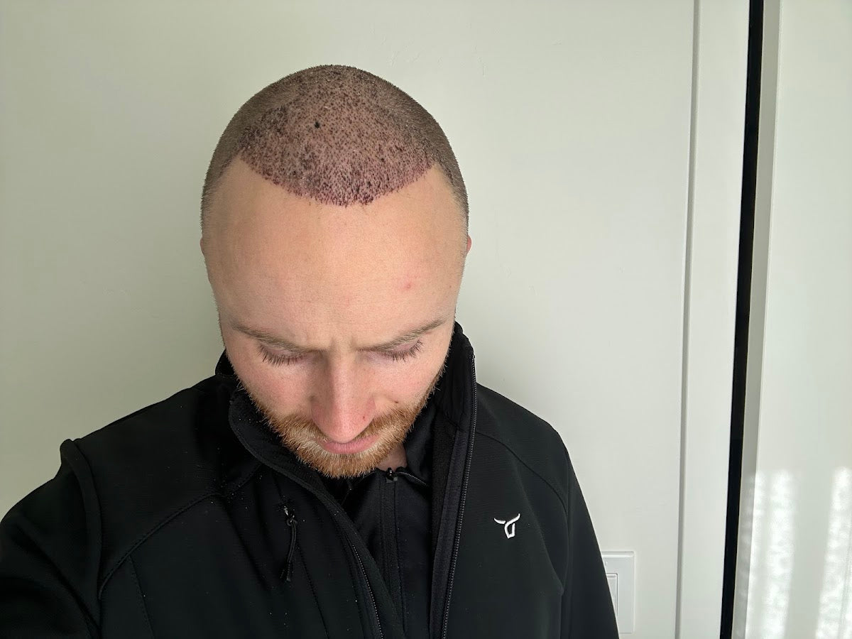 Smile Hair Clinic Hair Transplant Turkey Istanbul | Hair Transplant | Alptekin Cd. No:15, MO