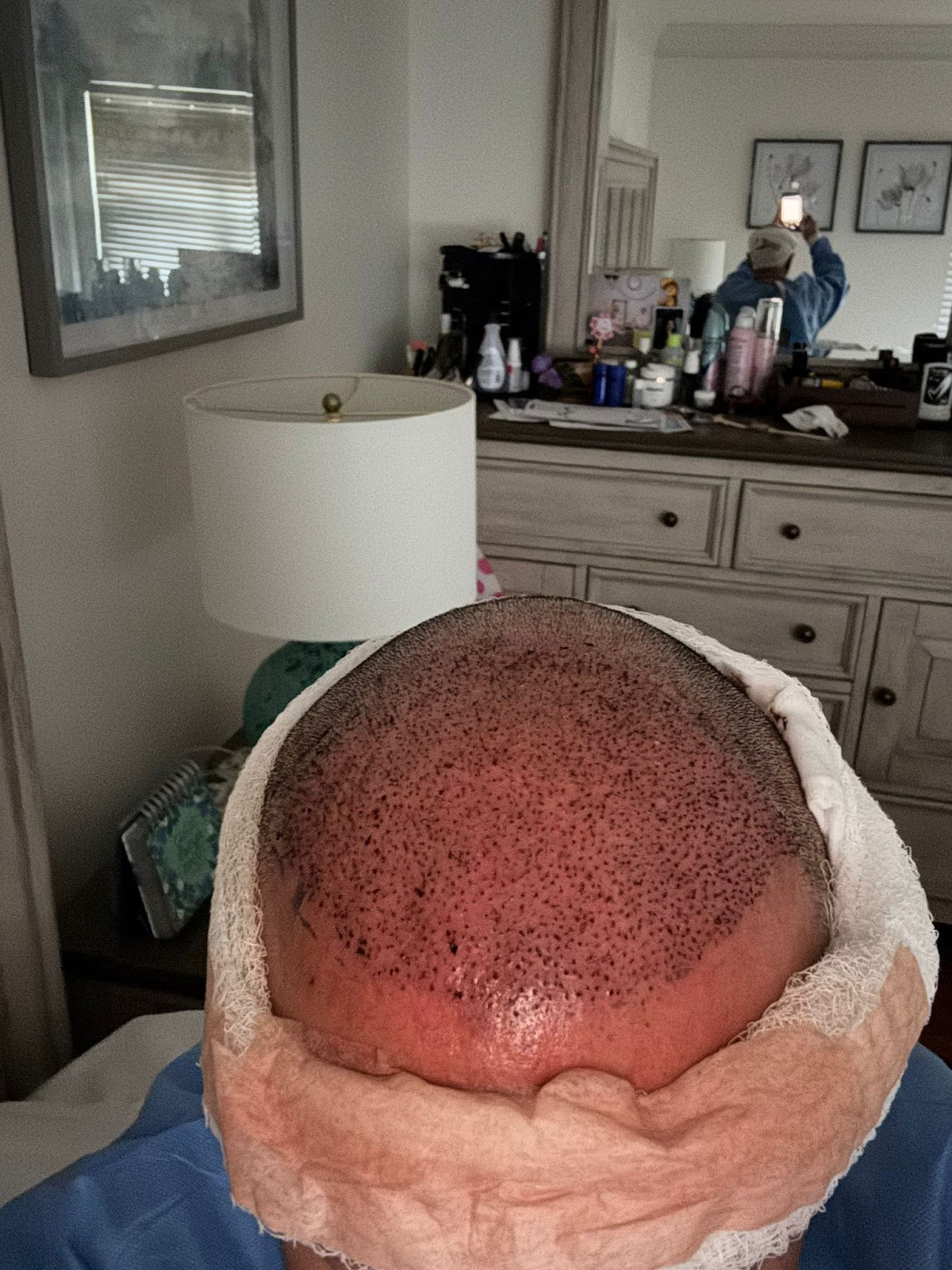 Mane Center for Hair Restoration | Hair Transplant | Chevy Chase, MD