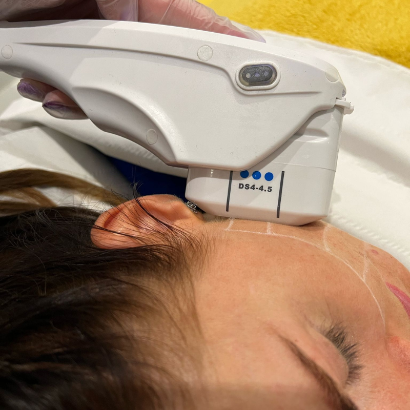 Fat Freezing and Facelift Belfast — photo 4