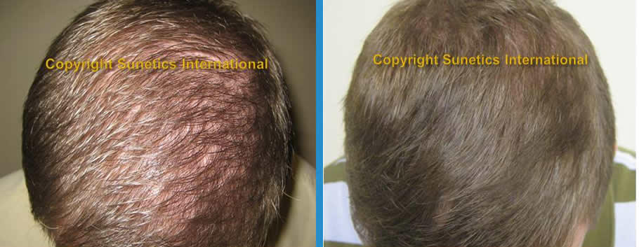 Hair Growth Clinic of Ct | Hair Transplant | Fairfield, CT