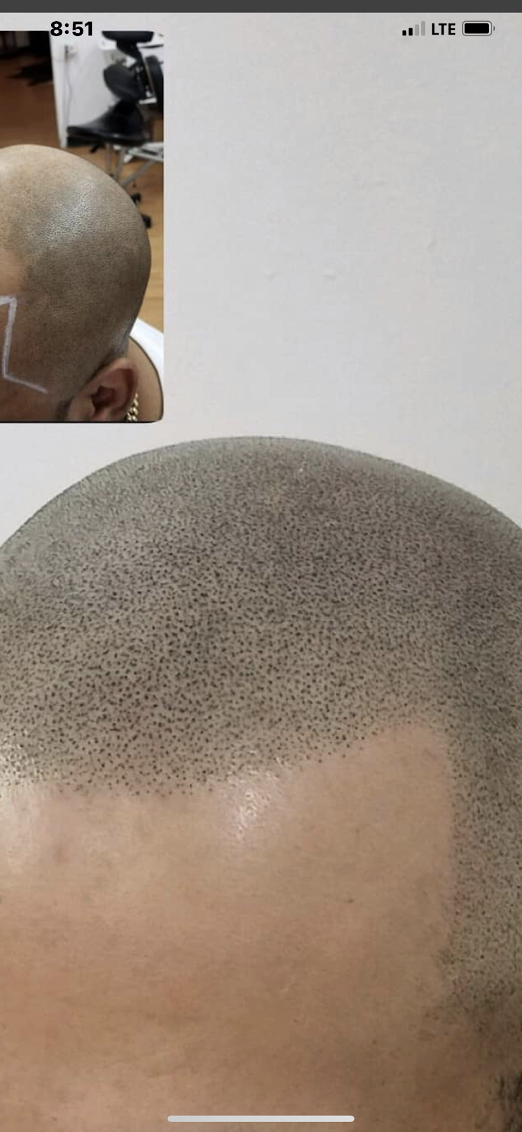 Royal scalp Micro LLC | Hair Transplant | Albuquerque, NM