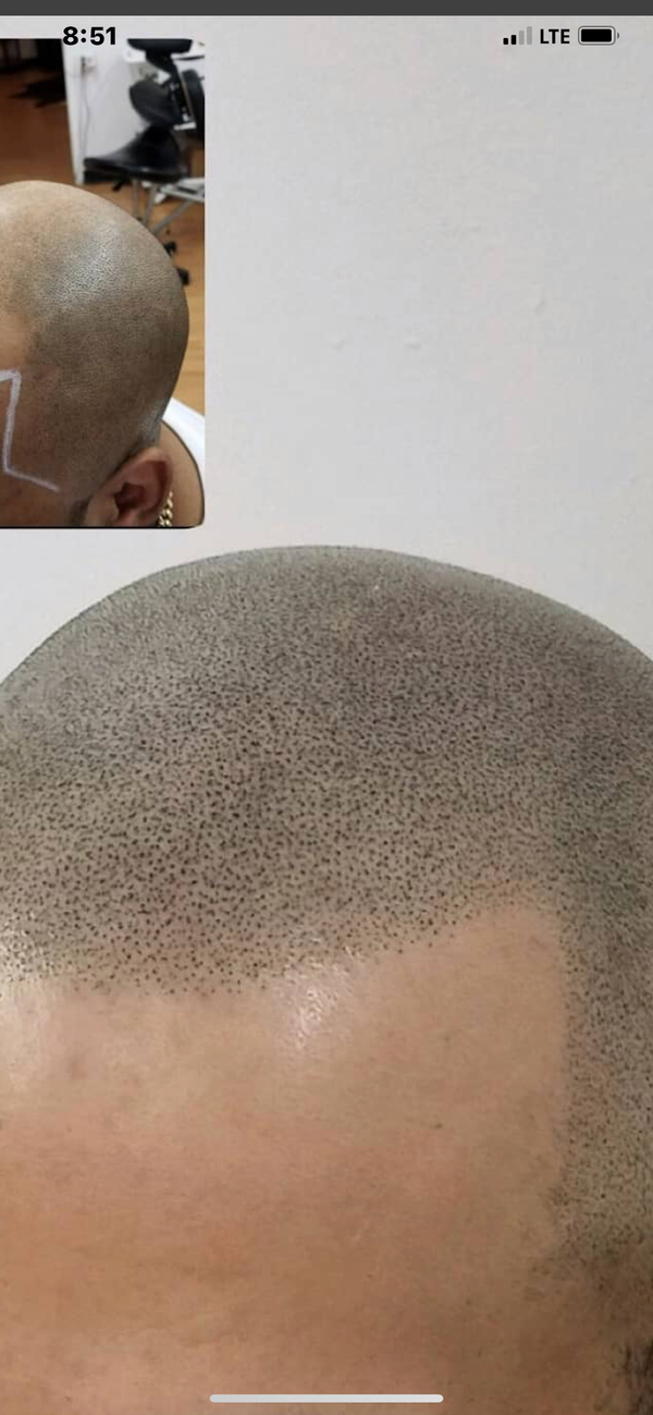 Royal scalp Micro LLC | Hair Transplant | Albuquerque, NM