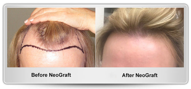 Hair Transplant | Hair Transplant | Glen Burnie, MD