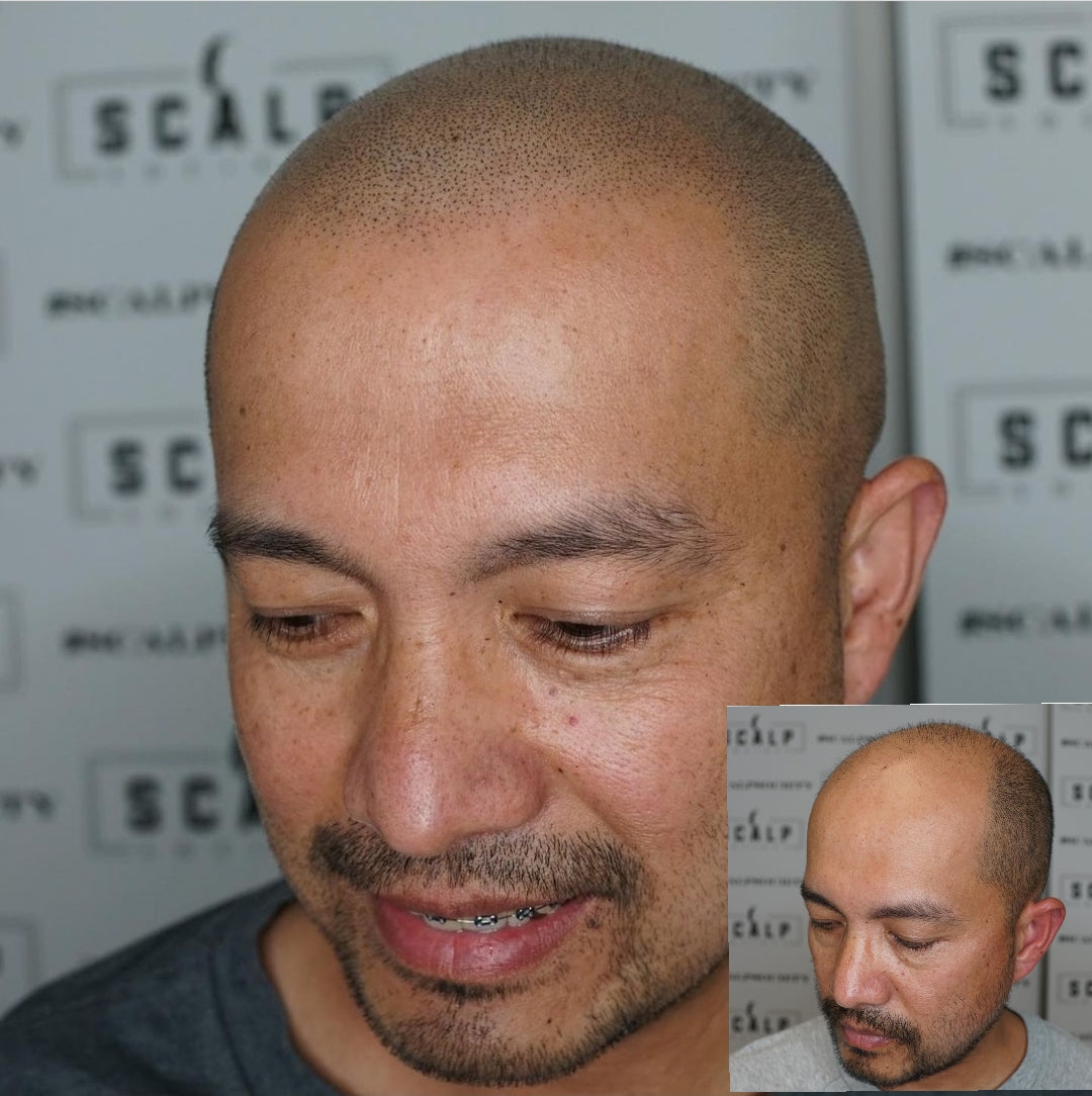 Scalp Society - Scalp Micropigmentation | Hair Transplant | Honolulu, HI