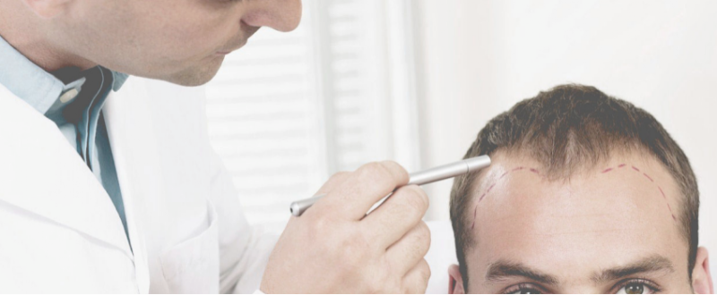 Billig Hårtransplantation | Hair Transplant | 1127 København