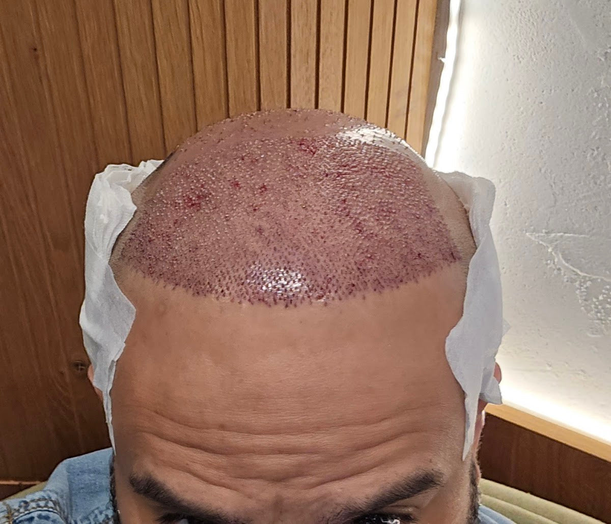 Hair of Istanbul | Hair Transplant Clinic — Dr.Visor photo 5