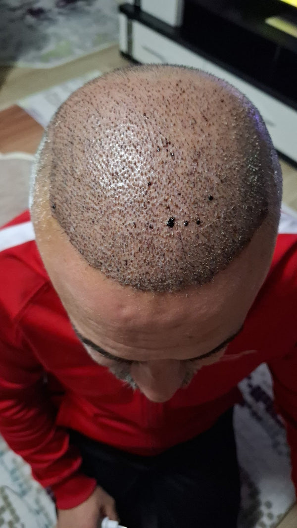Vialux Hair Transplant | Ankara Saç Ekimi