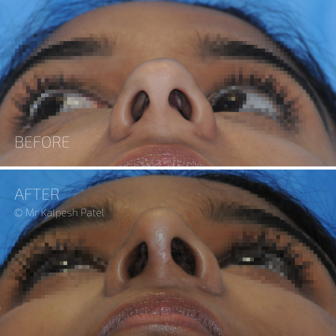 London Rhinoplasty — photo 4