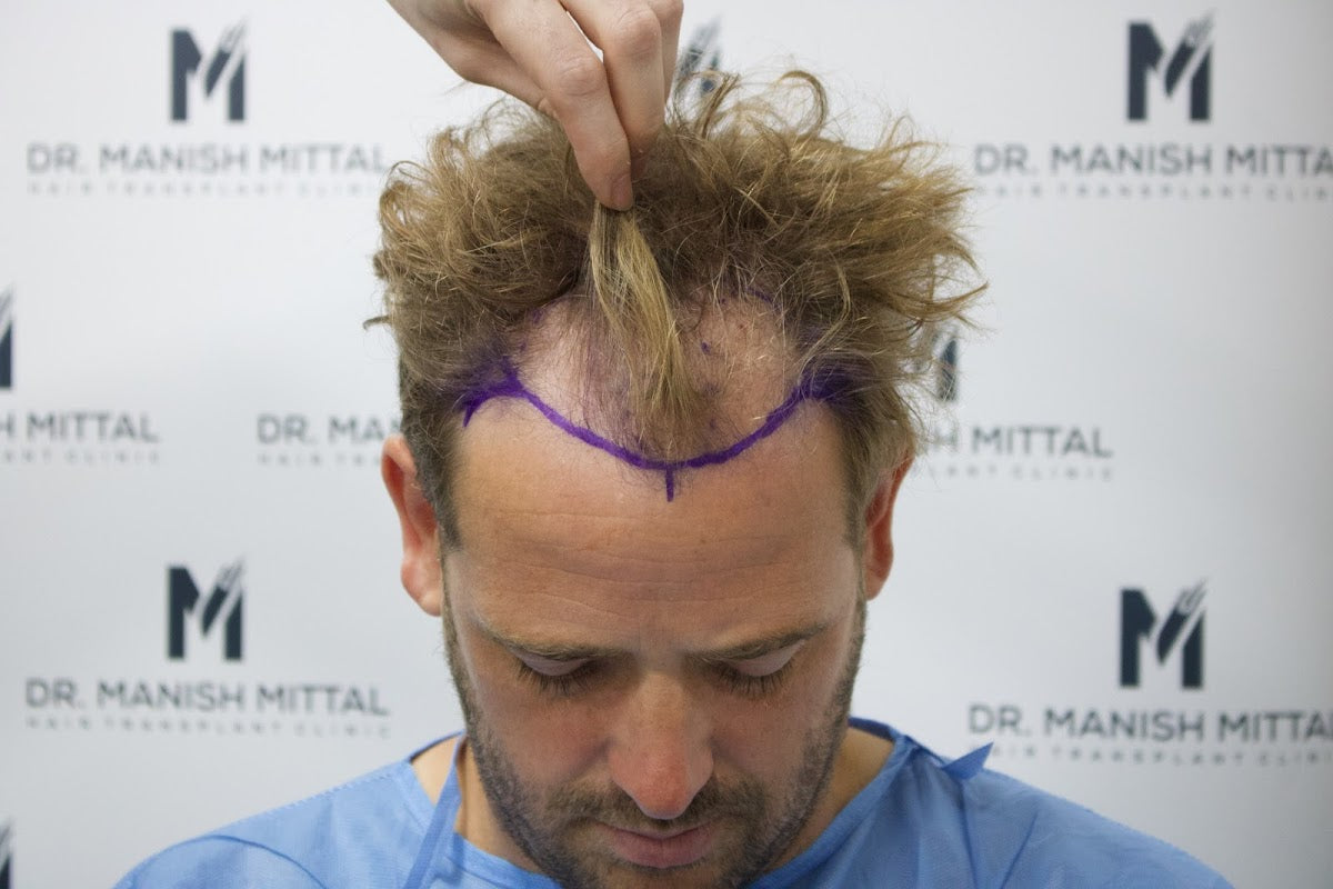 Mittal Hair Clinic — Hair Transplant Clinic in London
