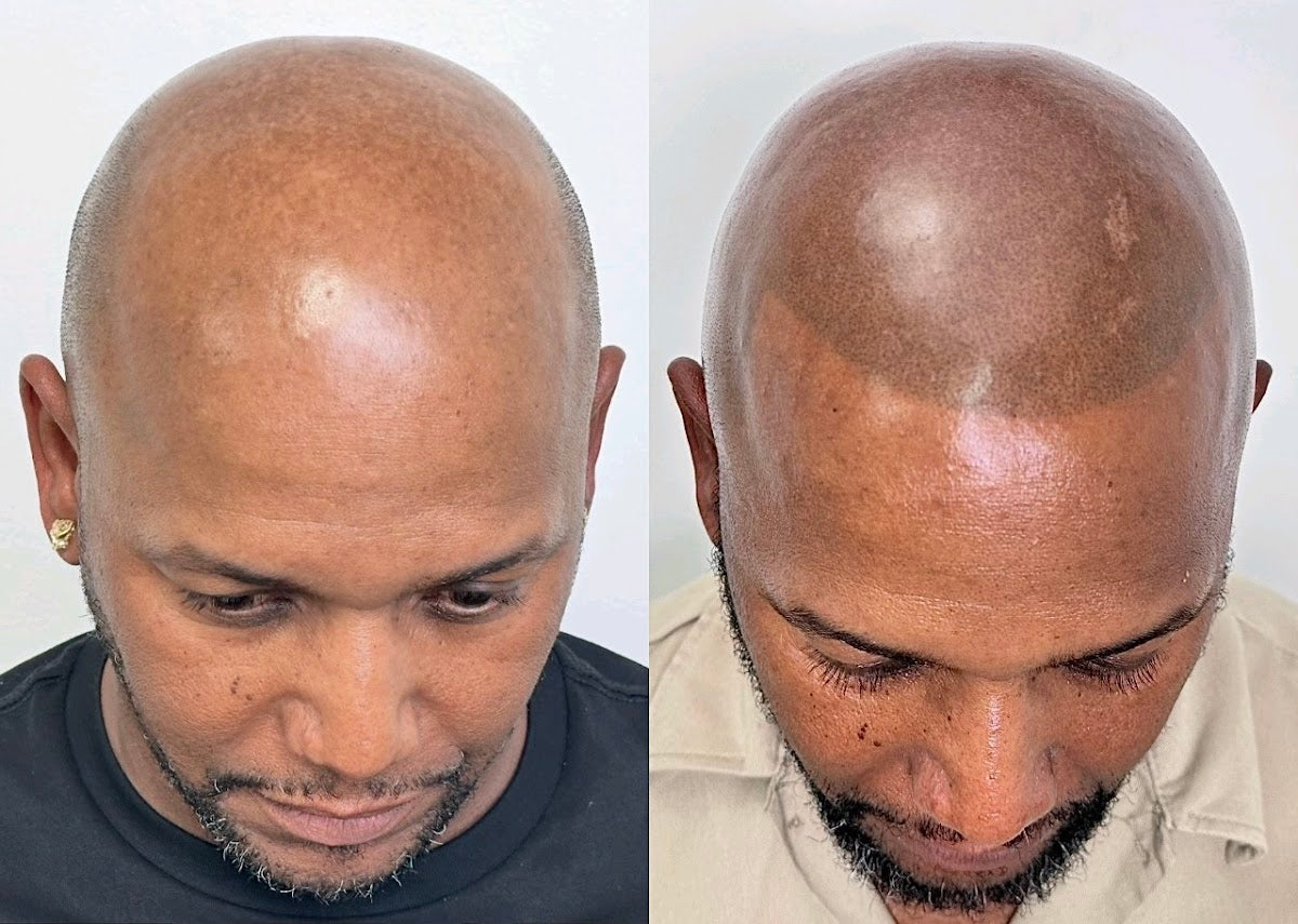 Oracle SMP | Scalp Micropigmentation Studio | Hair Transplant | Metairie, LA