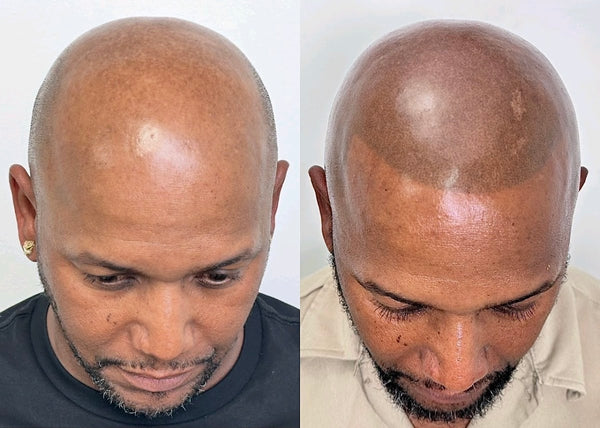 Oracle SMP | Scalp Micropigmentation Studio | Hair Transplant | Metairie, LA