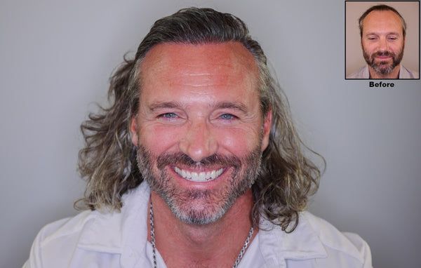 Alvi Armani - Salt Lake City, UT | Hair Transplant | Salt Lake City, ID