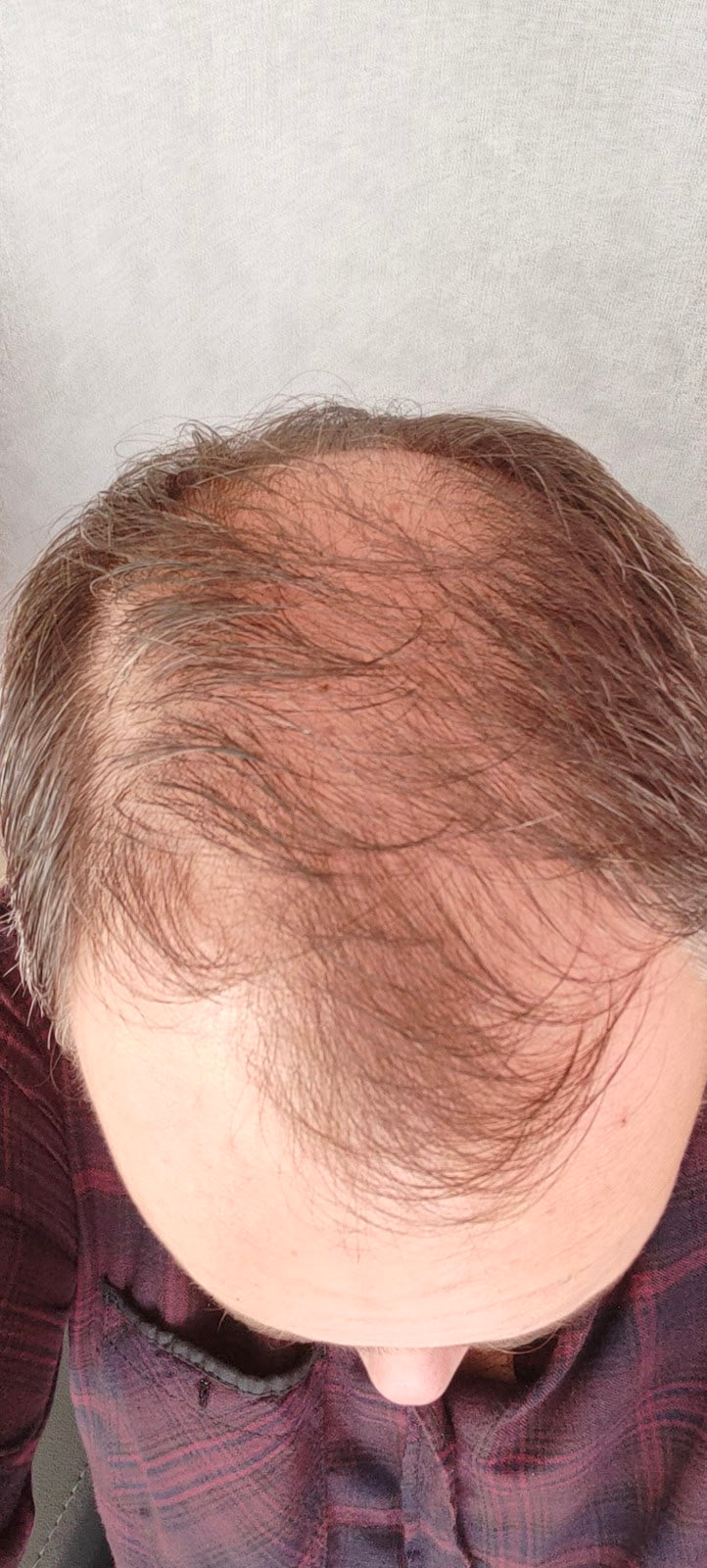 Prp Saç Tedavisi İzmir | Ossi Hair | İzmir Saç Ekimi | Mezoterapi İzmir | PRP İzmir — Dr.Visor photo 4