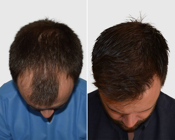 Seneca Medical Group | Hair Transplant | Edinburgh