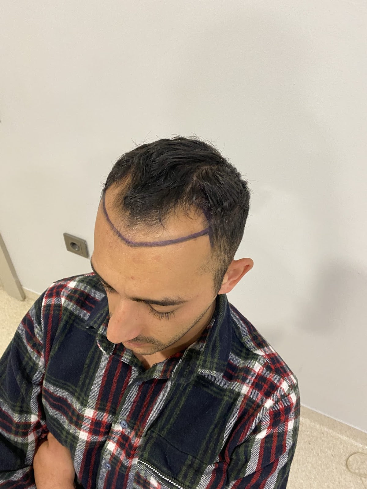 Akdeniz Antalya Saç Ekimi - Hair Transplant Antalya — Dr.Visor photo 3