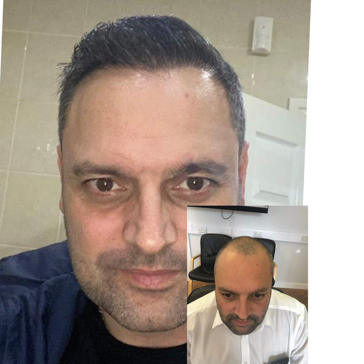 Hair Transplant Solutions — photo 4