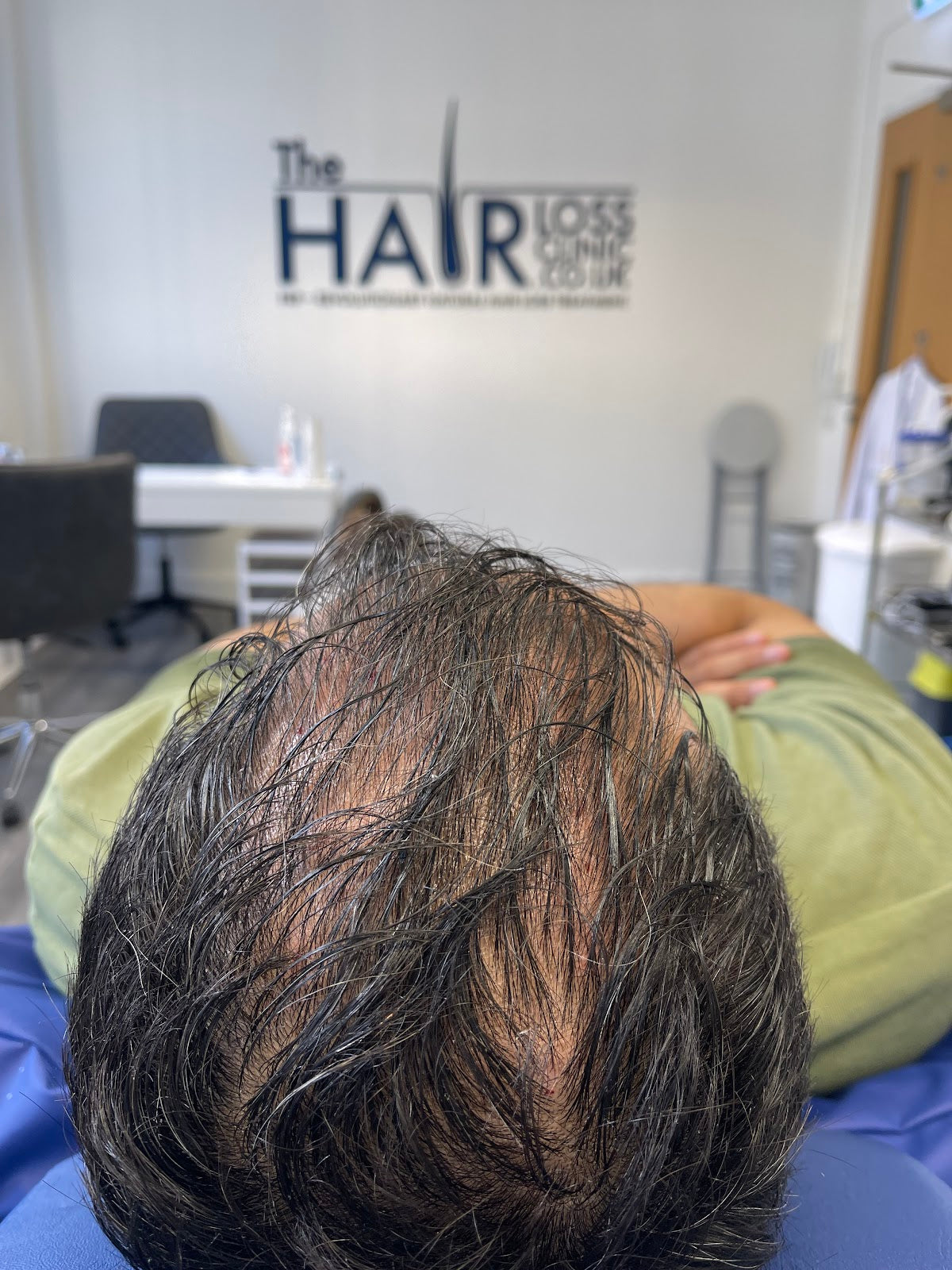 The Hair Loss Clinic | PRP + PRF Injections £195* | Exosomes | Steroid Alopecia Treatment — photo 2