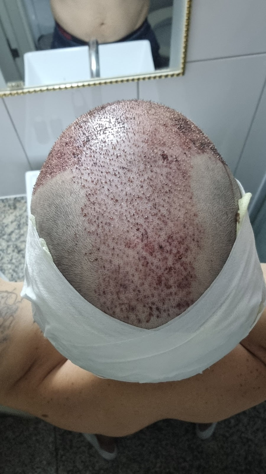 BT Hair Clinic Antalya | Saç Ekimi Merkezi — Dr.Visor photo 4