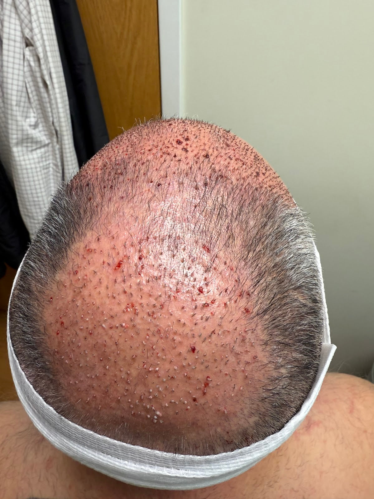Oak Brook Hair Transplant | Hair Transplant | Oak Brook, WI
