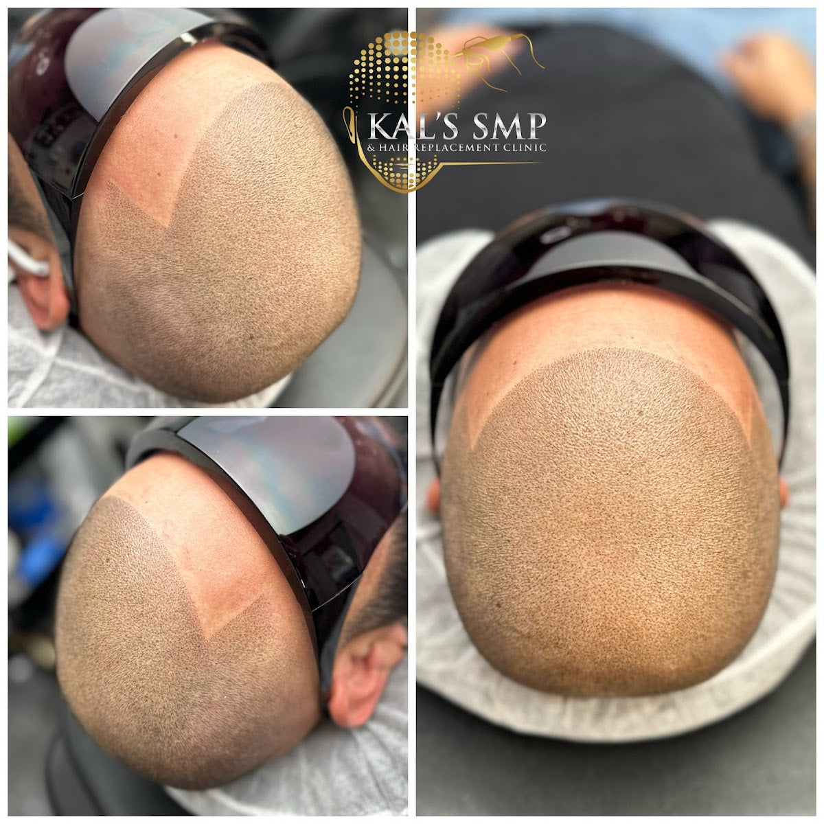 KAL’s SMP & Hair Replacement Clinic | Hair Transplant | Colorado Springs, CO