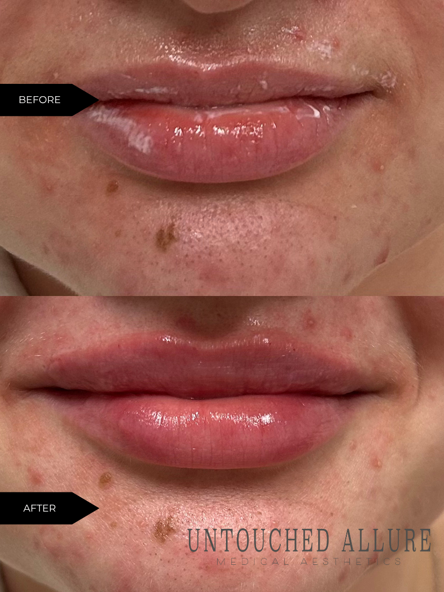 Untouched Allure Medical Aesthetics | Hair Transplant | Dover, NH