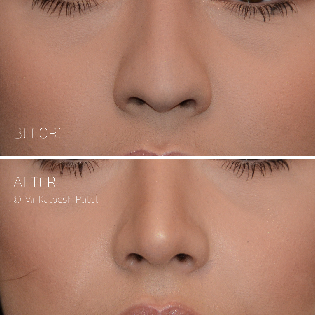 London Rhinoplasty — photo 2