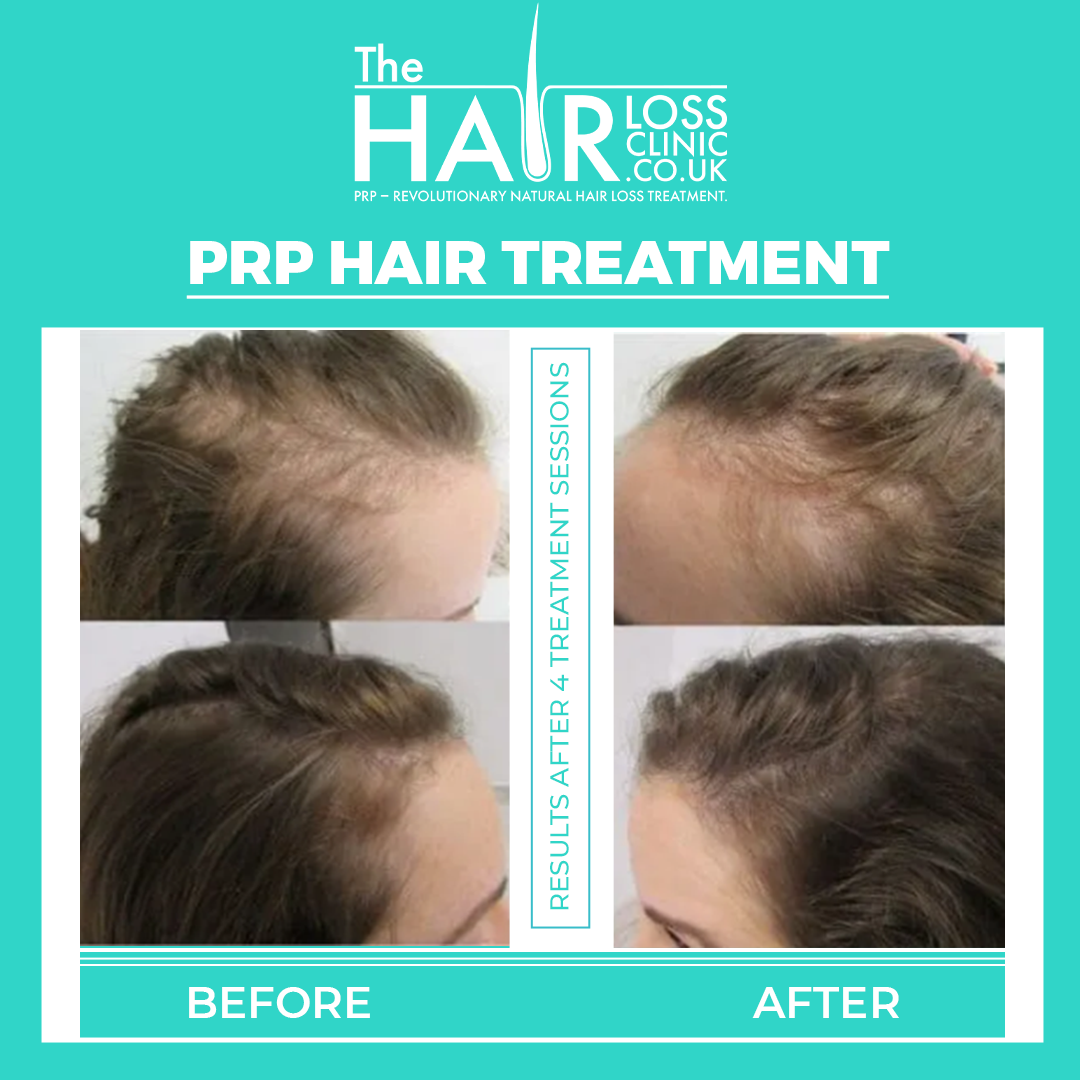 The Hair Loss Clinic | PRP + PRF Injections £195* | Exosomes | Steroid Alopecia Treatment — photo 5