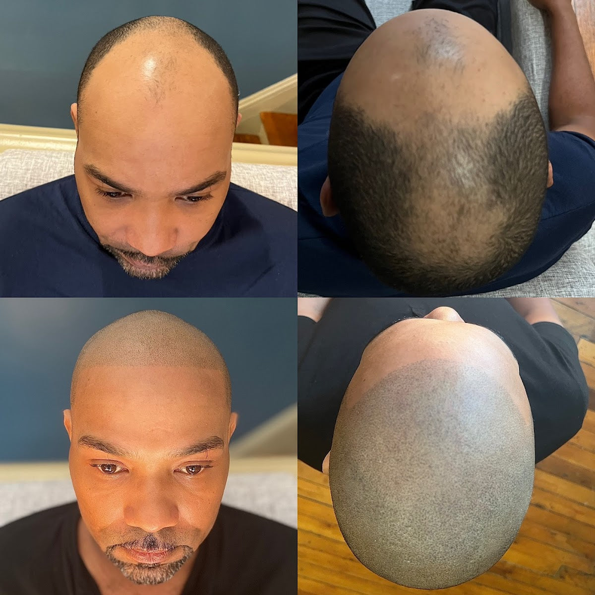 Scalp Headquarters LLC | Hair Transplant | Kansas City, MO