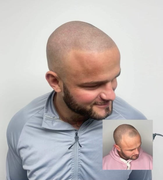 The Hairline Guy — Hair Transplant Clinic in Leeds