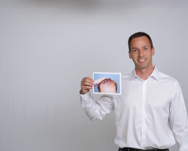 Hair Restoration | Hair Transplant | Kirkwood, MO