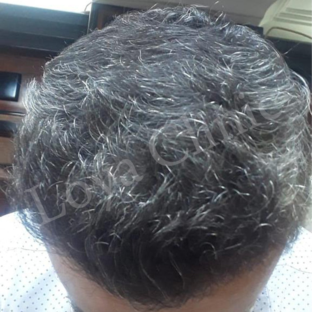 İzmir Saç Ekim Merkezi | Loya Clinic | Fue saç ekimi | İzmir saç PRP ve Mezoterapi | Sakal ekimi | Kaş ekimi — Dr.Visor photo 2