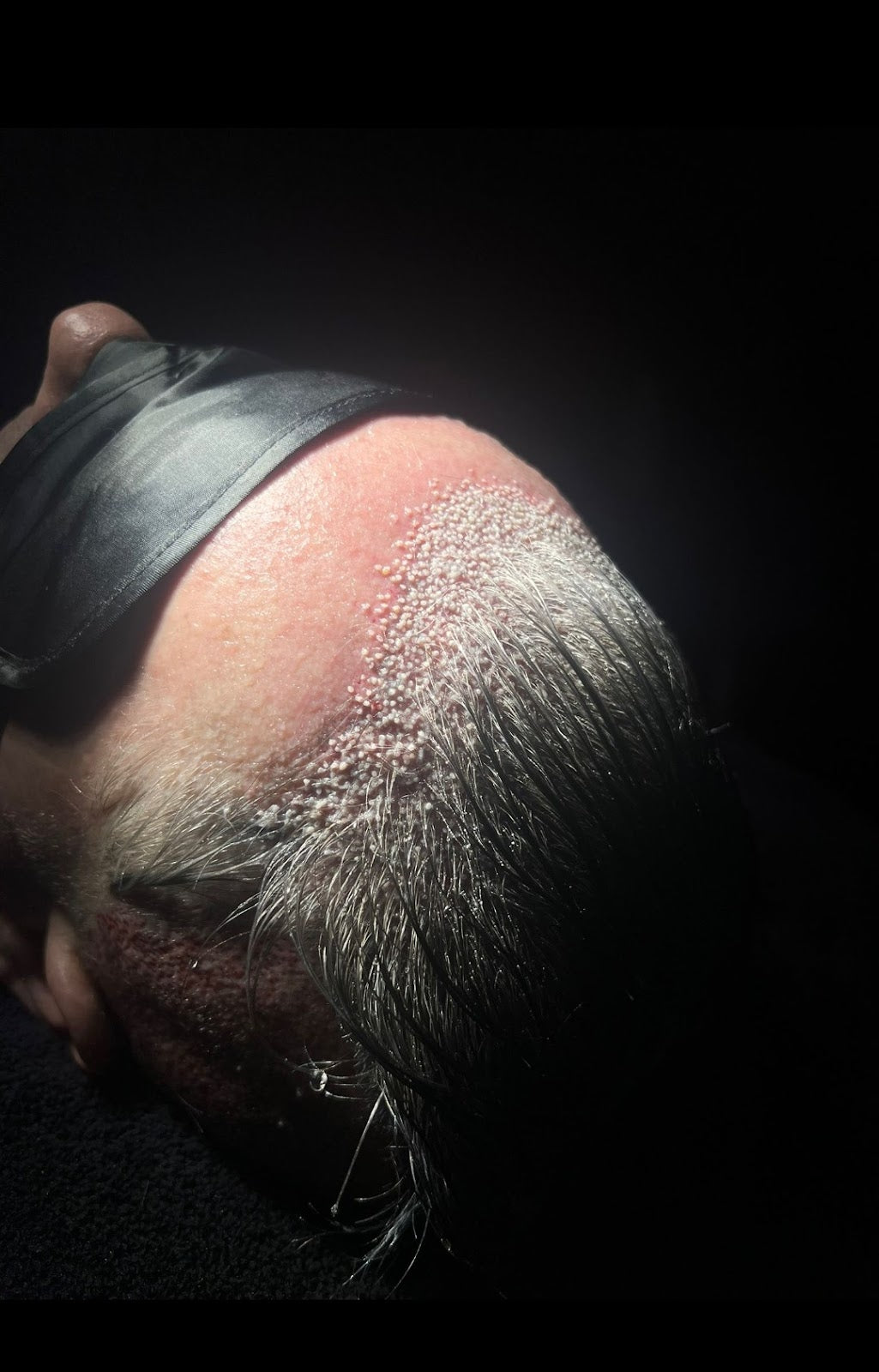 Robotic DHI UK Hair Transplant — Dr.Visor photo 5