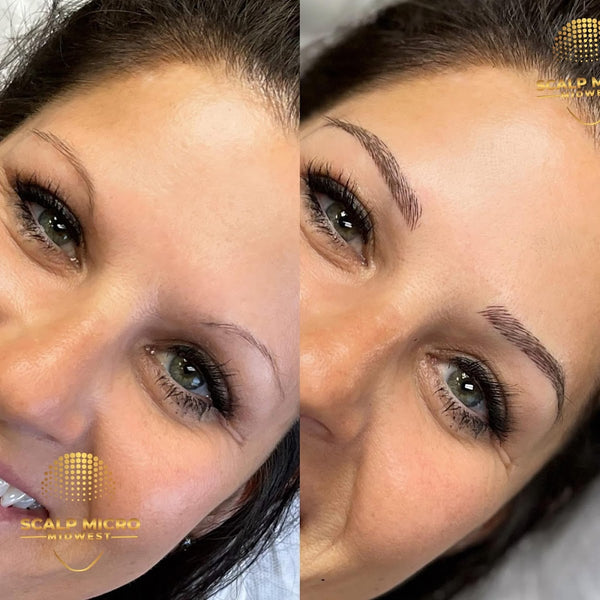 Scalp Micro Midwest PMU | Hair Transplant | Wichita, KS