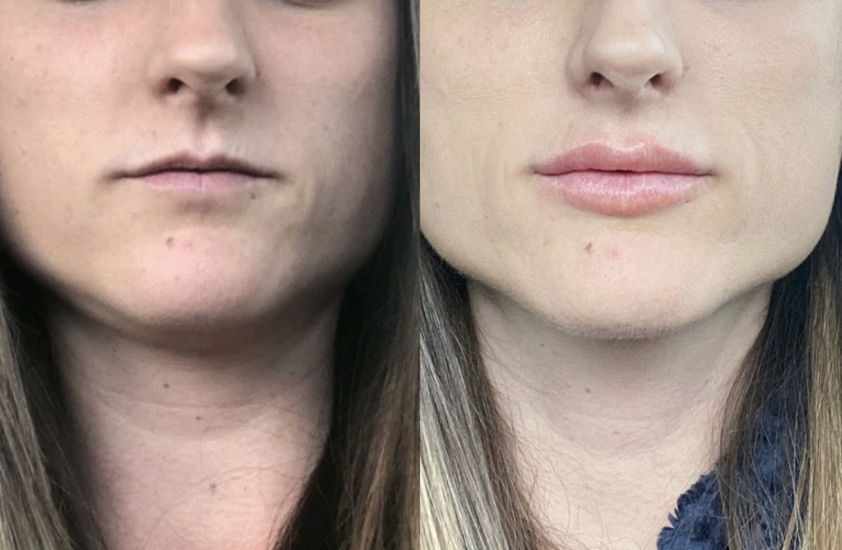 Cult Medical Aesthetics | Hair Transplant | Nampa, ID