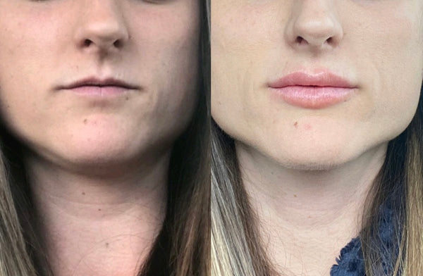 Cult Medical Aesthetics | Hair Transplant | Nampa, ID