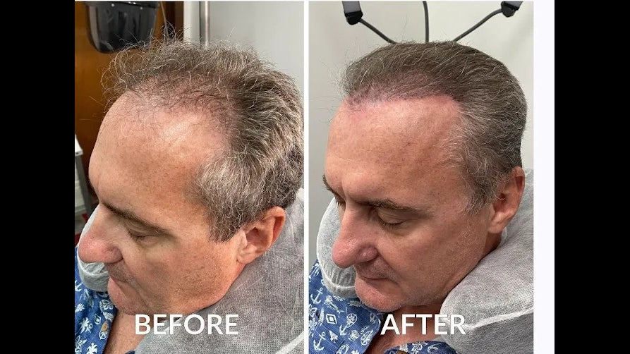 Hair Restoration & Wellness | Hair Transplant | Encino, NH