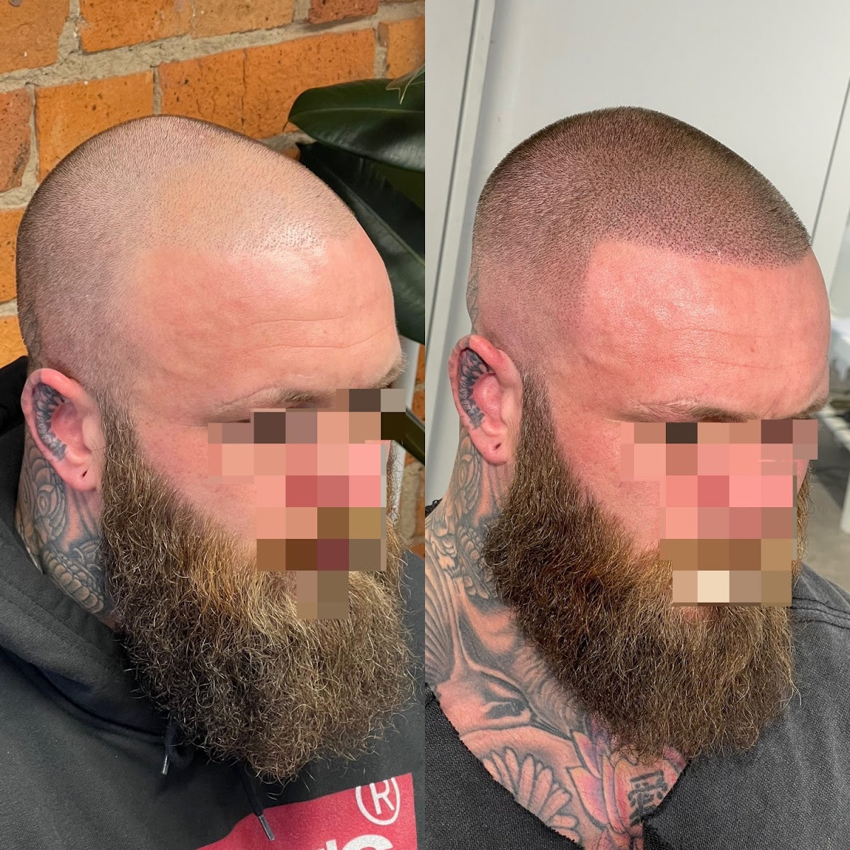 Alter Ego Hair Clinic - Hair Transplant clinic in Cardiff, United Kingdom