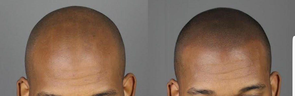 Pro Scalp | Hair Transplant | Germantown, MD