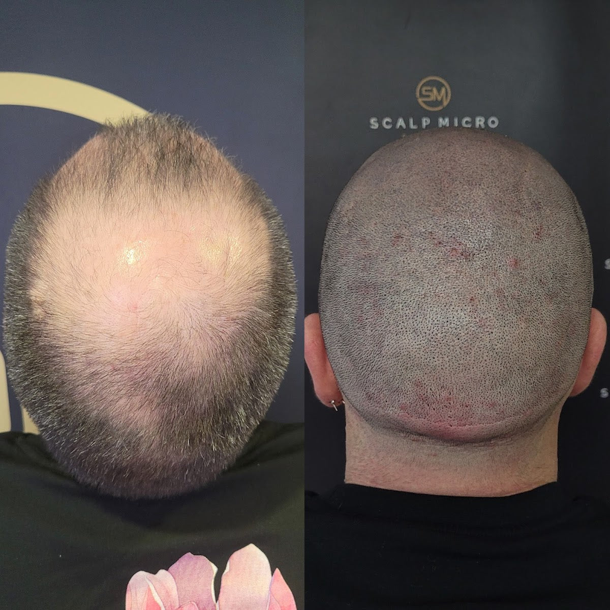 Scalp Micro Scotland - Hair Transplant clinic in Glasgow, United Kingdom