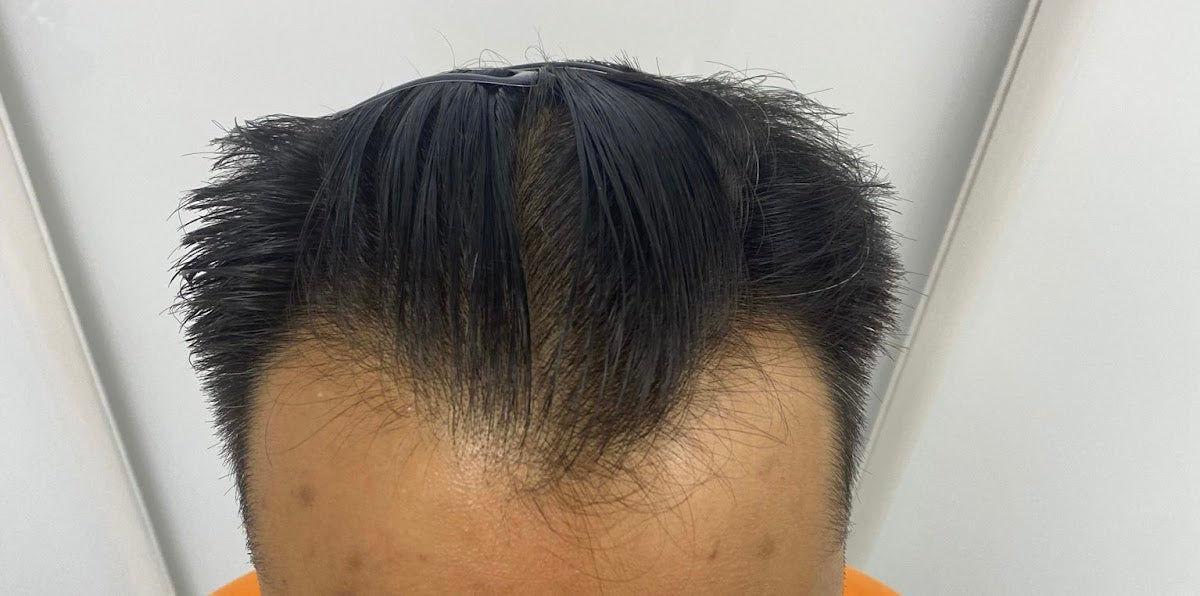 London Hair Transplant Clinic — Hair Transplant Clinic in London