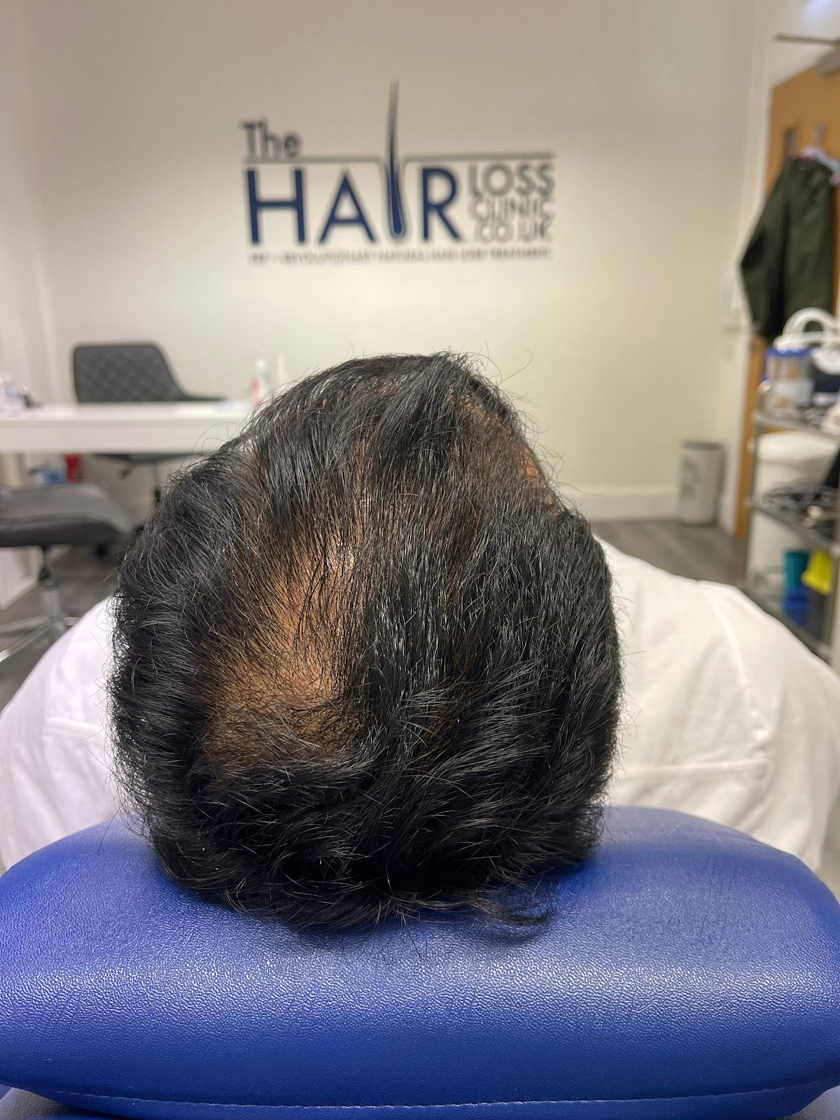 The Hair Loss Clinic | PRP + PRF Injections £195* | Exosomes | Steroid Alopecia Treatment — photo 3