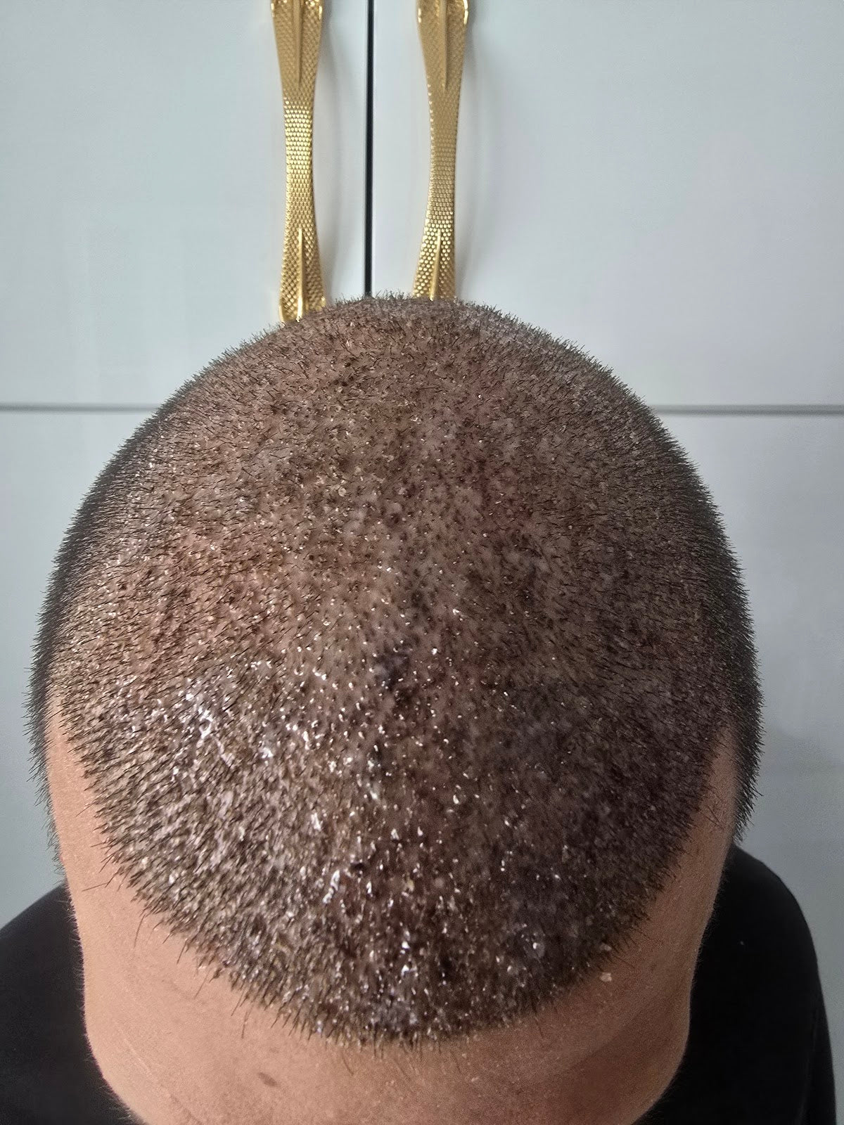 One Hair Clinic Transplantation - Plastic Esthetic — Dr.Visor photo 4