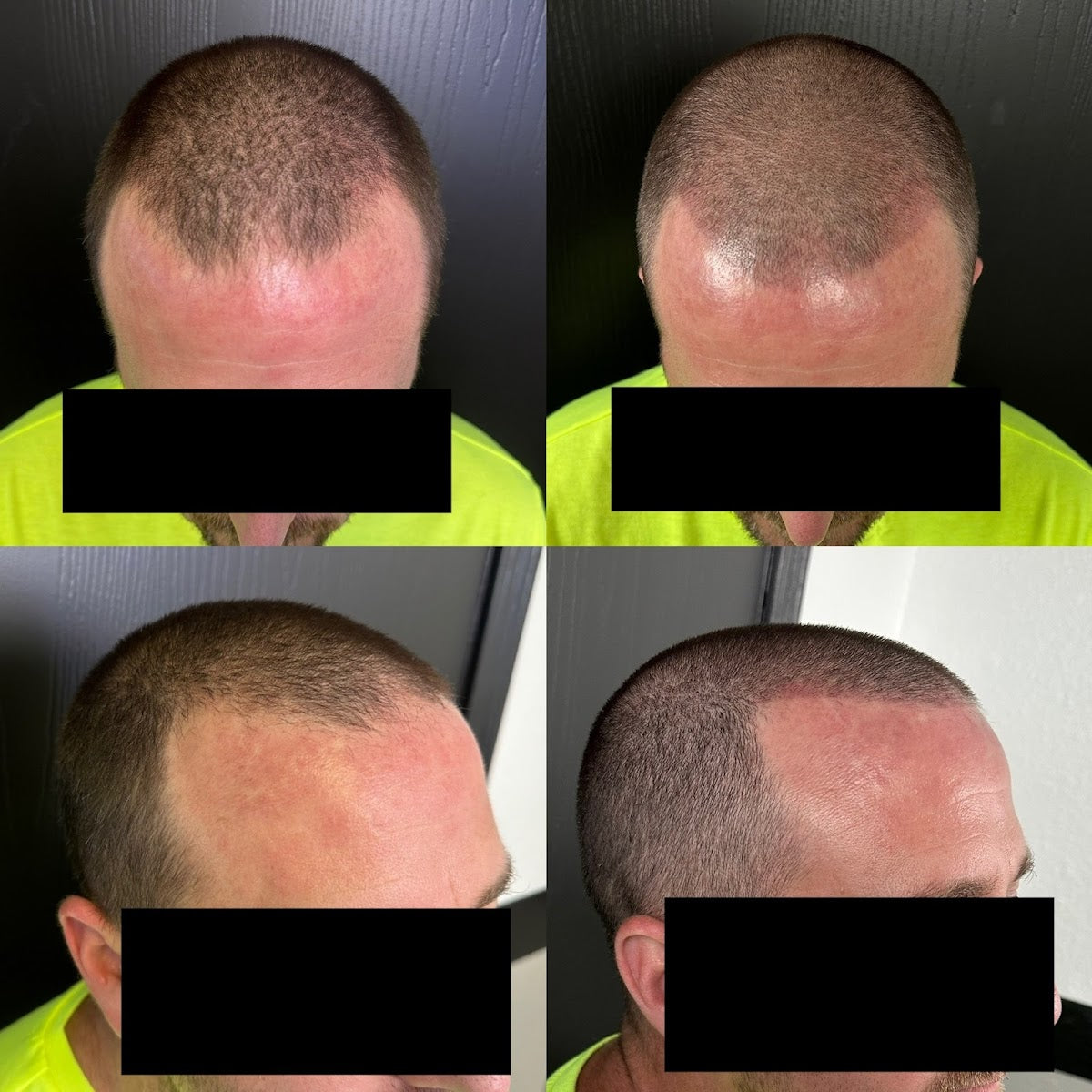 No Cap Hair Loss Solutions | Hair Transplant | Evansville, IN