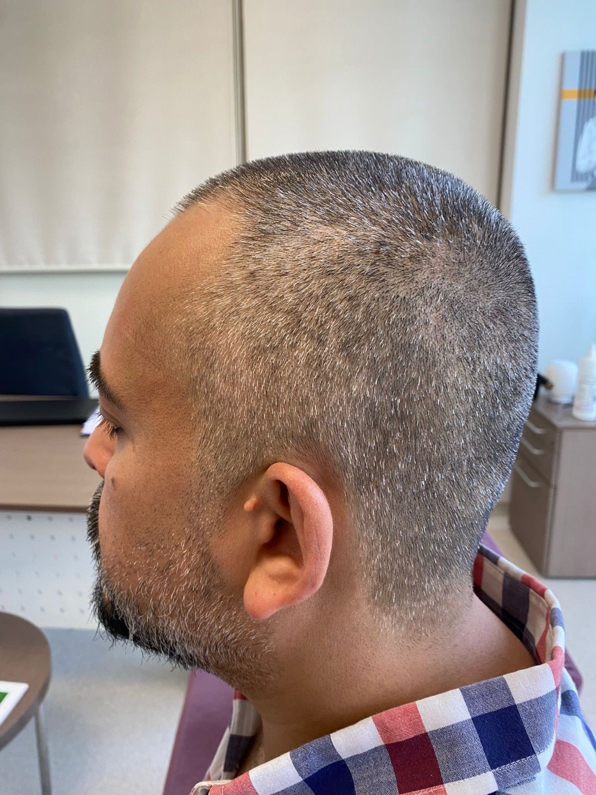 Bilyana Hair Transplant — Dr.Visor photo 4