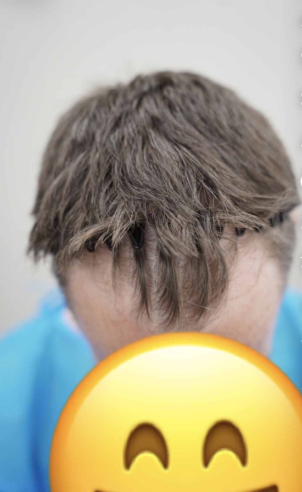 Robotic DHI UK Hair Transplant — photo 5