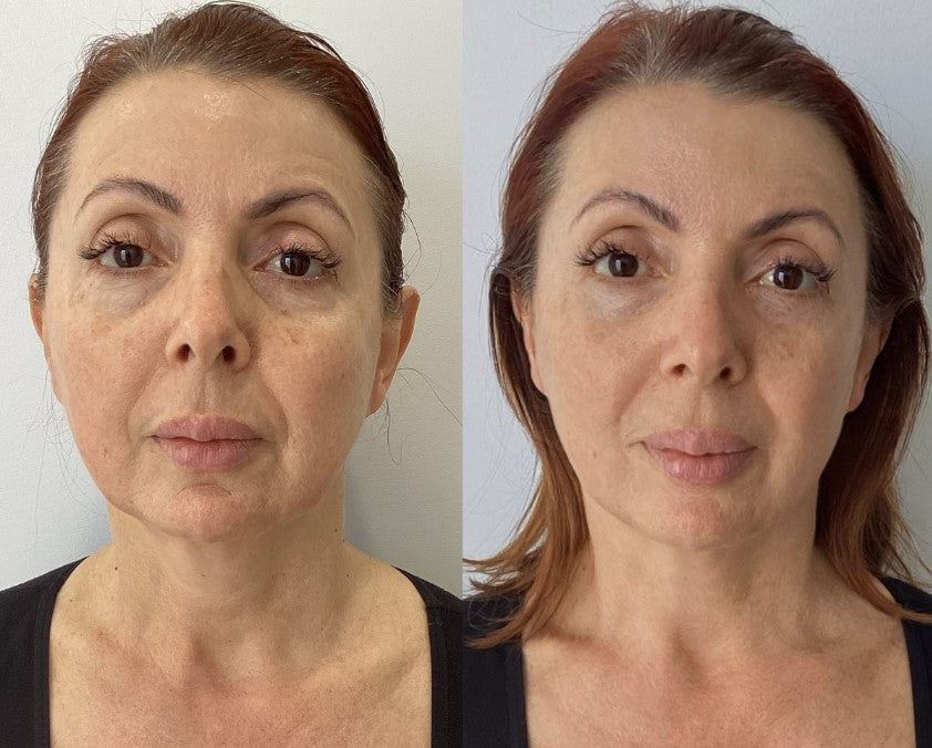 HIFU Facelift Clinic Leeds — photo 3