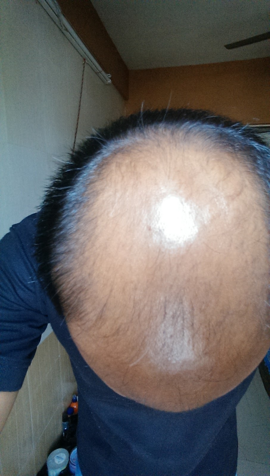 UK Hair Transplant Clinics Manchester — photo 2